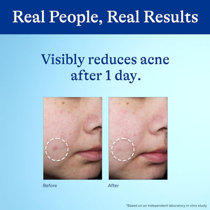 Differin 10% Benzoyl Peroxide Spot Treatment – Quick Study-Break Skincare for Focus Weeks, 1 oz Gel