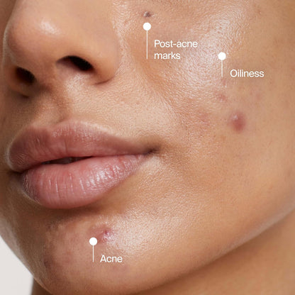 Neutrogena Evenly Clear Acne Clay Mask – Dermatologist-Recognized, Fragrance-Free Formula Safe for Daily and Weekly Use