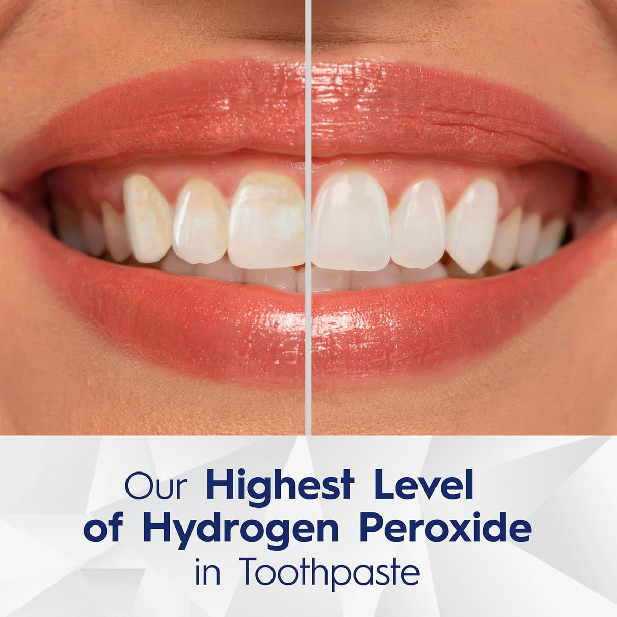 sodium monofluorophosphate (0.17% fluoride ion) for anticavity protection