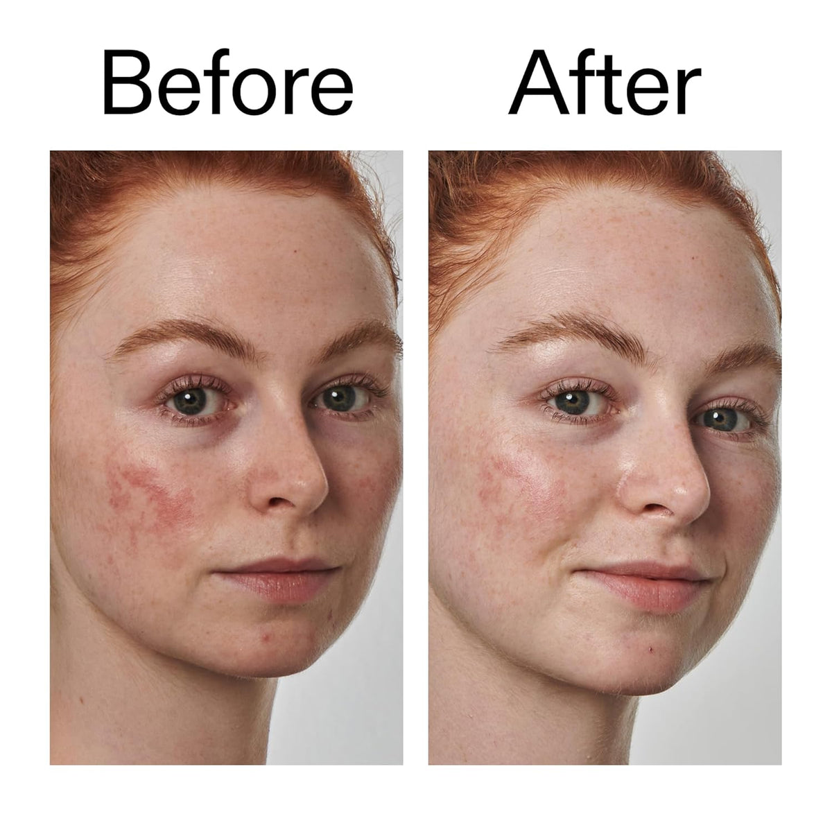 The INKEY List SuperSolutions Azelaic Acid 10% Serum – Thoughtful Skincare Gift for the Redness-Prone Friend